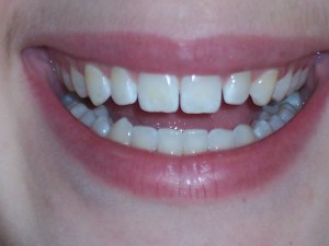 Before Dental Bonding Case Study