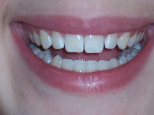 Before Dental Bonding Case Study