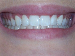 After Dental Bonding Case Study