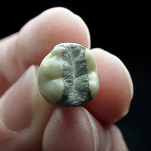 hand holding a tooth with amalgam fillings